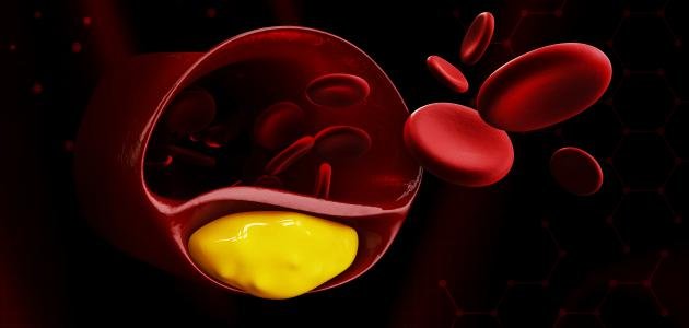 ارتفاع نسبة الدهون في الدم 