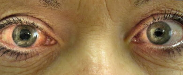 مرض المياه الزرقاء بالعين