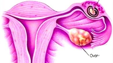 Photo of الحمل خارج الرحم| أسبابه،أعراضه، والعلاج