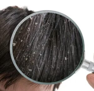أنواع قشرة الشعر- وكيفية العلاج 