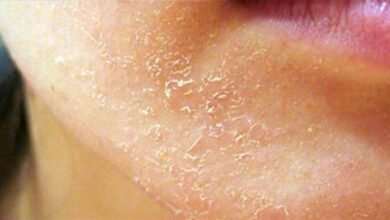 Photo of كل ما تريد معرفته عن أمراض الجلد في الصيف